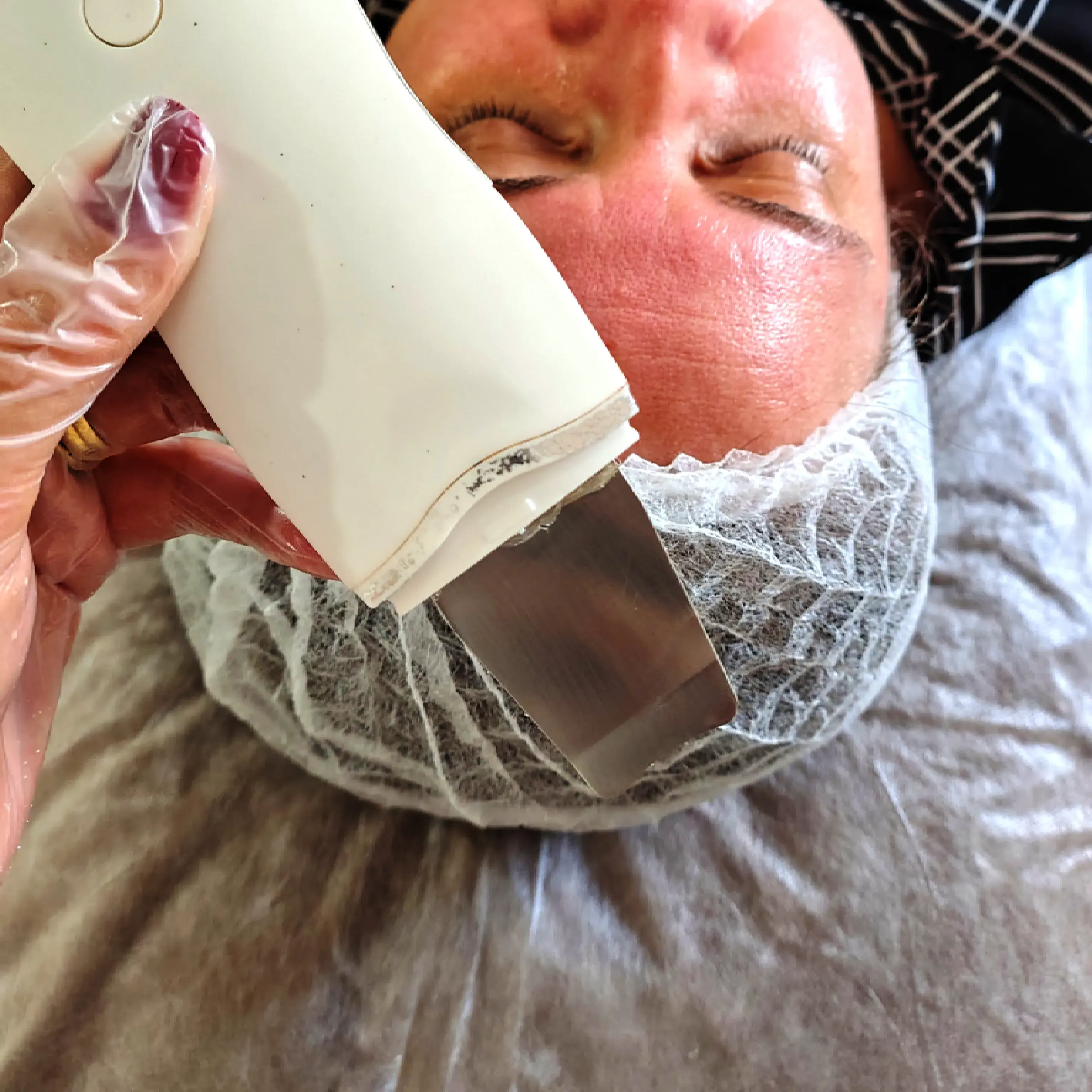 Tecnologia estetica aplicada em protocolo facial